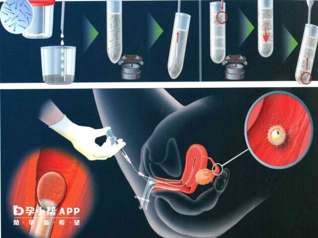 试管婴儿取卵移植手术的全过程图
